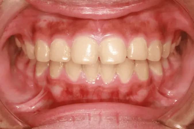 Czy zapalenie dziąseł jest zakaźne? Rozwiewamy mity i obawy!