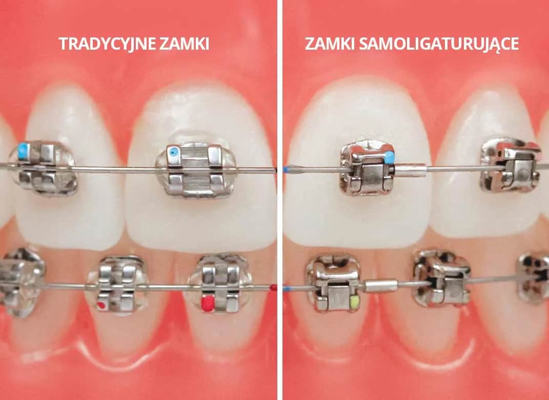 Ile trwa zakładanie aparatu na zęby? Czas wizyty i leczenia
