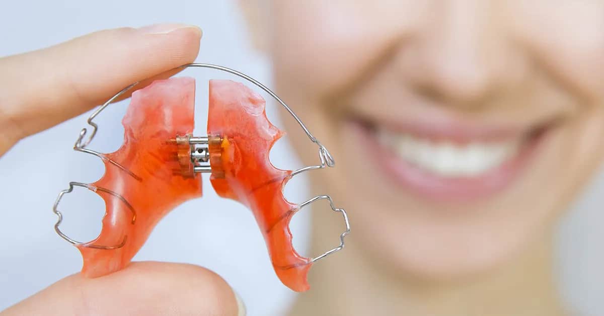 Ruchomy aparat ortodontyczny: Koszty, NFZ i ukryte wydatki