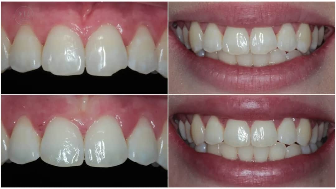 Ile licówek? Odkryj idealną liczbę dla Twojego uśmiechu!