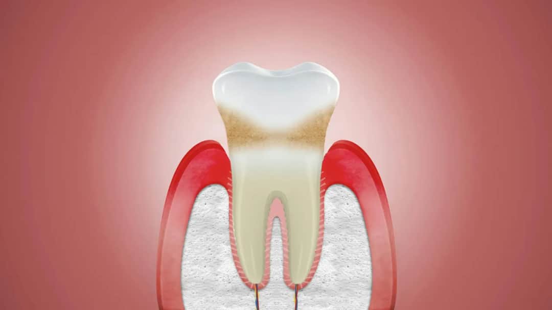 Uszkodzone dziąsła nie odrastają? Poznaj skuteczne metody leczenia
