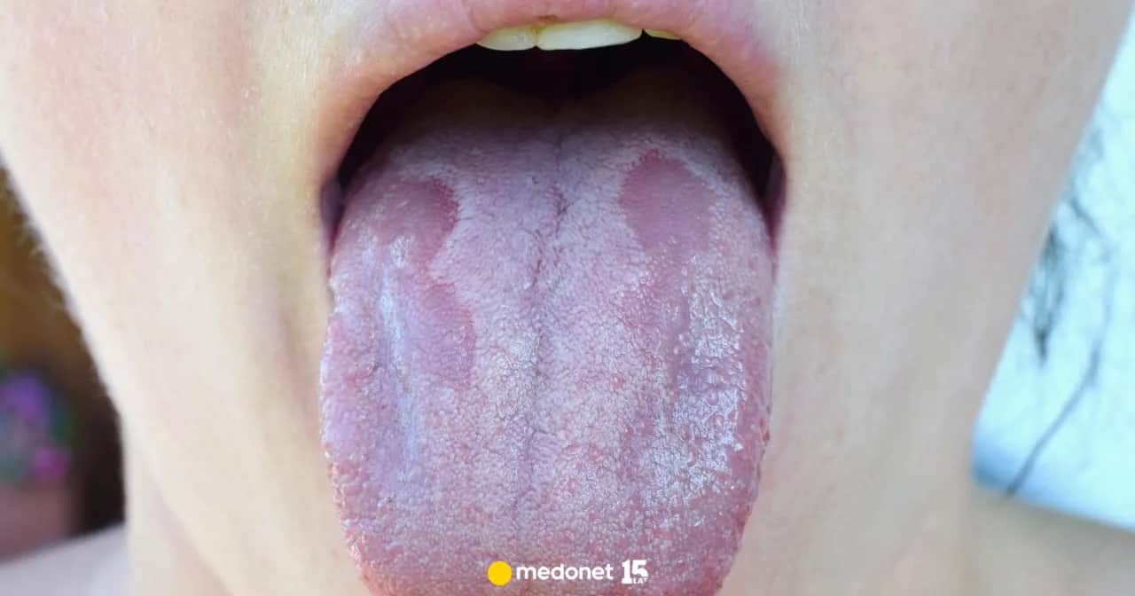 Czy grzybica jamy ustnej boli? Poznaj objawy i skuteczne leczenie.