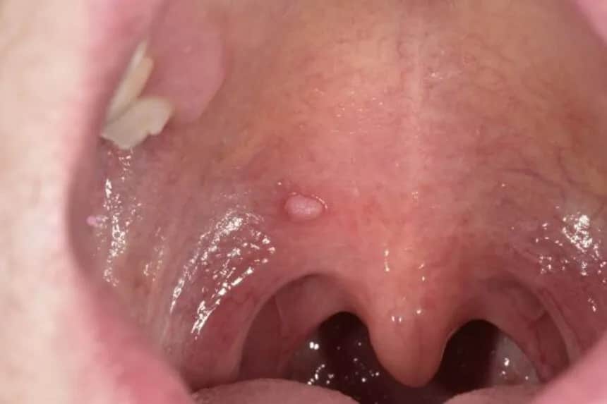 Objawy HPV w jamie ustnej: ciche sygnały, które ratują życie