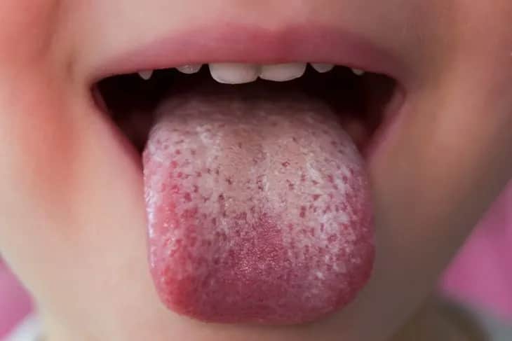 Grzybica jamy ustnej: objawy, zdjęcia, leczenie jak ją rozpoznać?