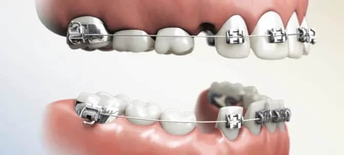 Aparat na zęby: Kto zakłada i jak wybrać najlepszego ortodontę?