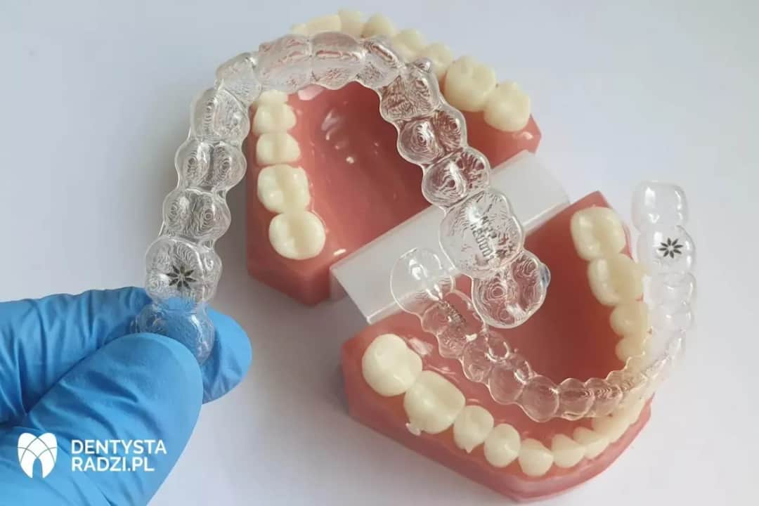 Aparat na dolne zęby: Ile kosztuje i czy warto leczyć tylko jeden łuk?
