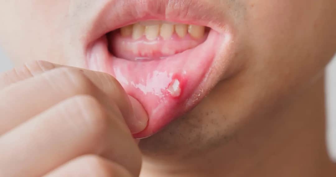 Masz opryszczkę? Dentysta odmówi! Co robić i kiedy iść?