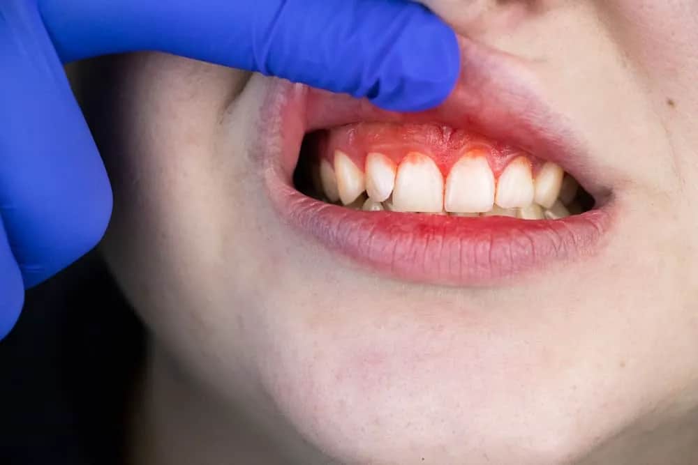 Ból dziąseł: co ci mówią? Przyczyny, leczenie i kiedy do dentysty